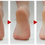 evolucion pies agrietados